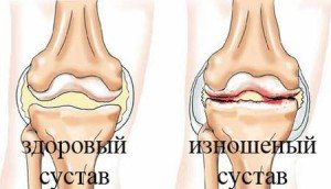 Деформирующий артроз