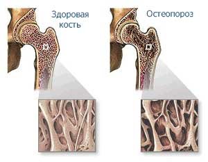 Заболевания из-за нехватки кальция