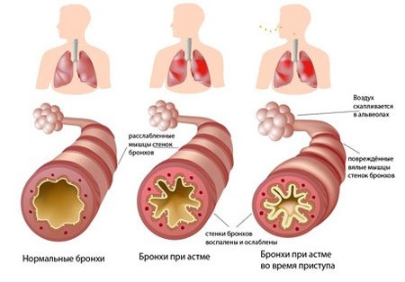 Приступы бронхиальной астмы