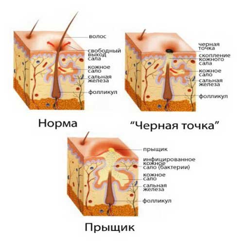 Образование прыщей на подбородке