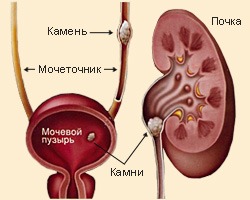 Камни в почках