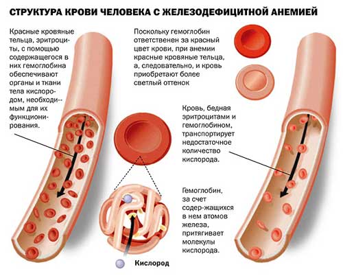 виды анемии