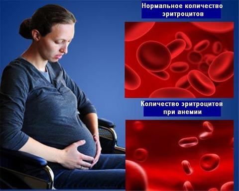 Лечение анемии и беременность