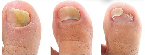 лечение грибка ногтей