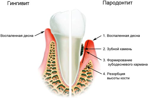 гингивит пародонтит