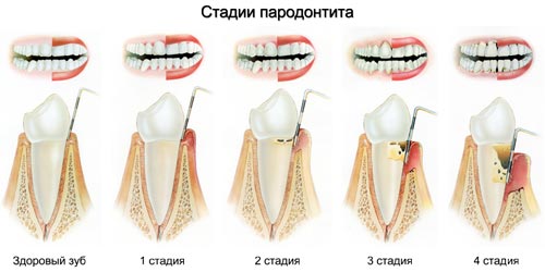 пародонтит