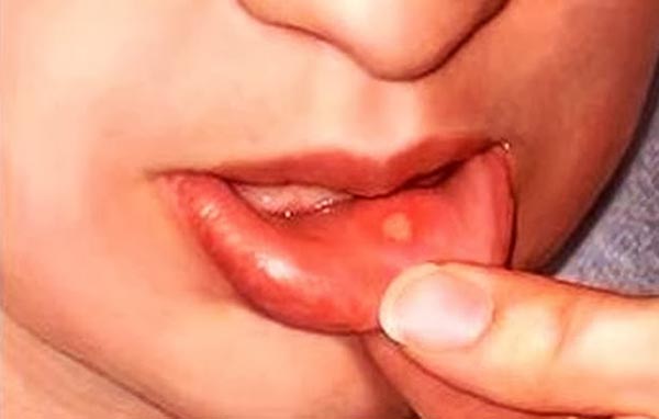 Язвочки во рту (стоматит): причины и лечение