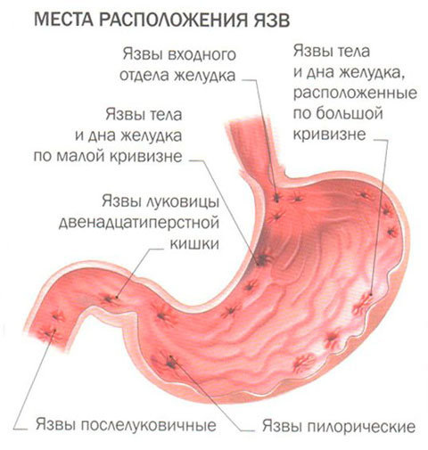 язва желудка