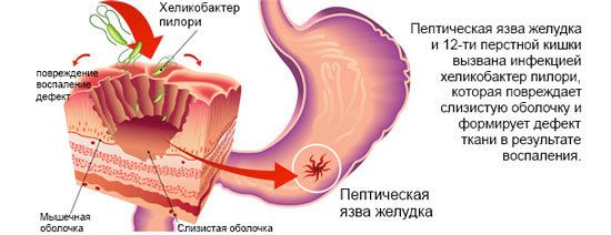 Язва желудка - Хеликобактер Пилори