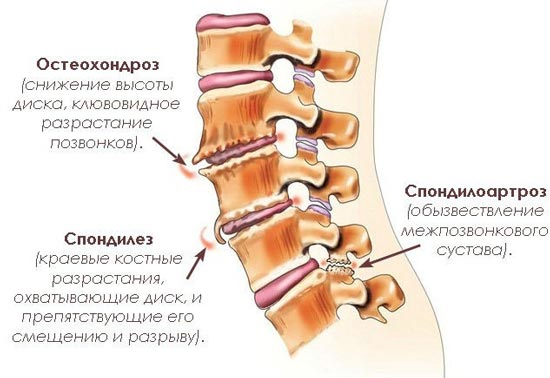 Боль в спине остеохондроз