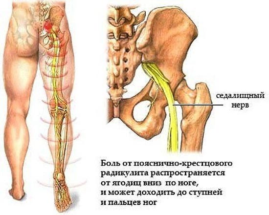 Боль в спине радикулит