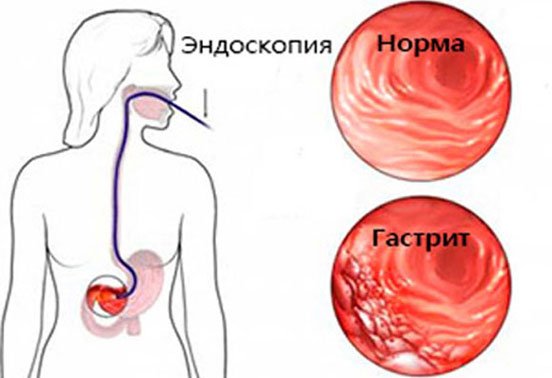 Гастрит с повышенной кислотностью