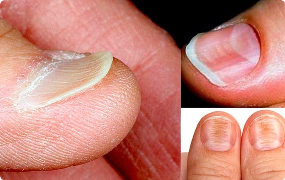 Ногти при железодефицитной анемии