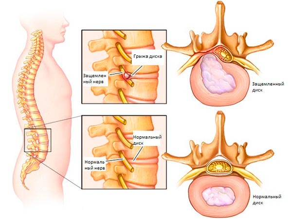 защемление нерва грыжа
