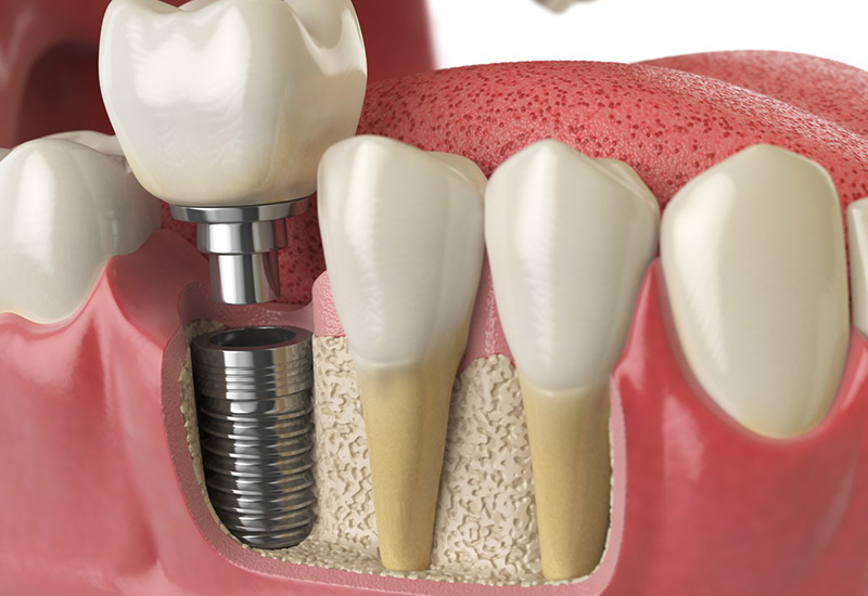 Какие бывают методы имплантации зубов?