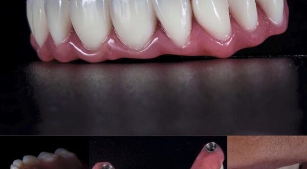 Протезирование зубов на 4 имплантах: преимущества и польза для вашей улыбки