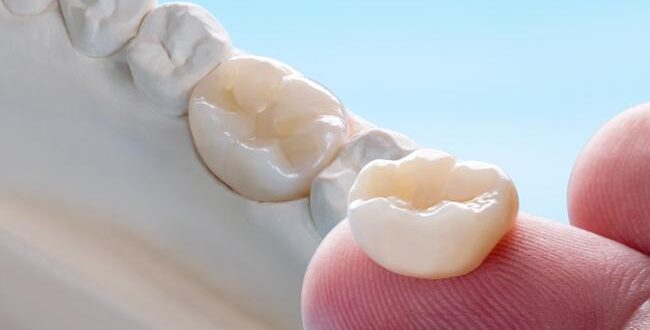 Как установить коронку на зуб: этапы, материалы, процесс