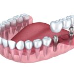 Имплантация при полном отсутствии зубов - самые эффективные методы