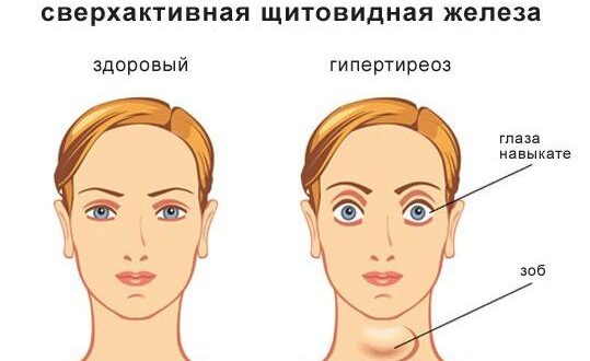 Симптомы заболеваний щитовидной железы на что обратить внимание